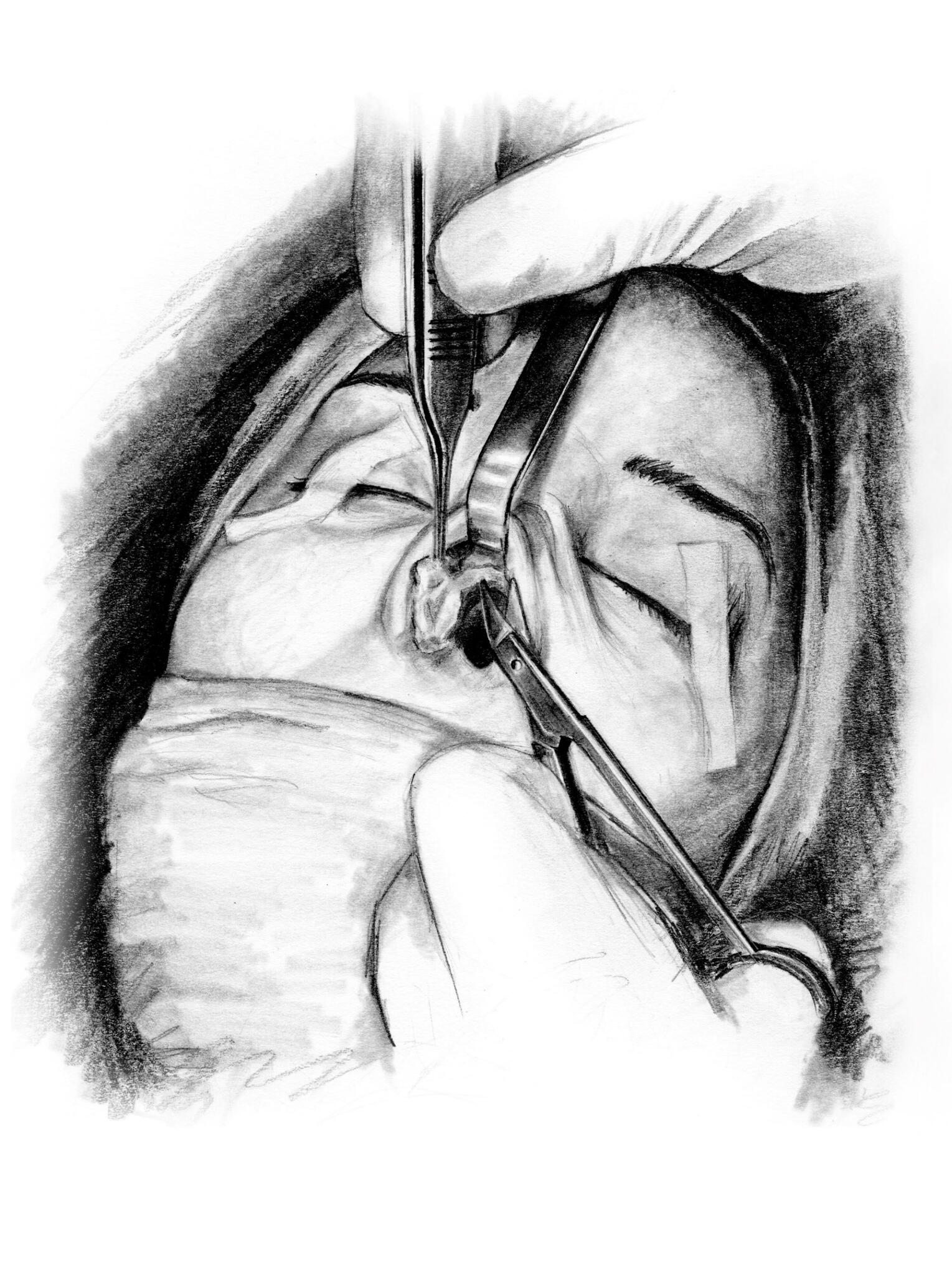 Rhinoplasty | Graphite, 2021